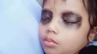 (Viral) Kisah Anak “Mata Hitam” Karena Kecanduan HP